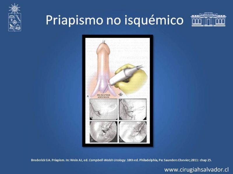 Diapositiva 33 de Priapismo