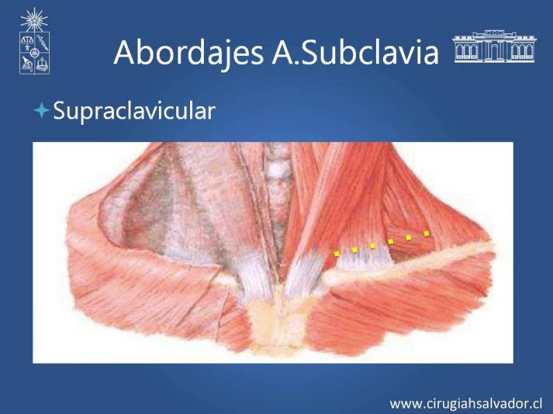 Diapositiva 21 de Anatomía Quirúrgica y Accesos de Carótida, vertebrales y subclavia