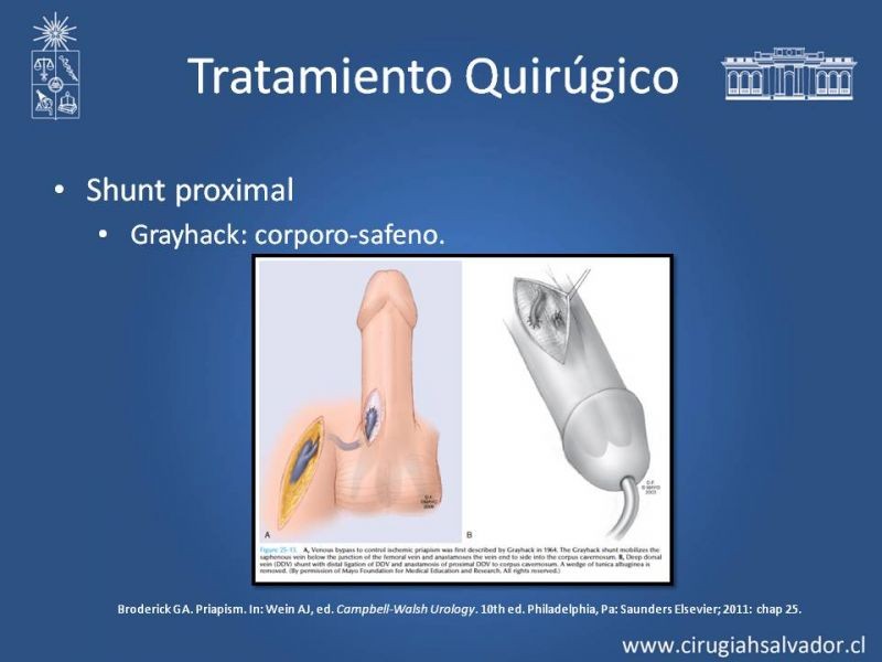 Diapositiva 29 de Priapismo