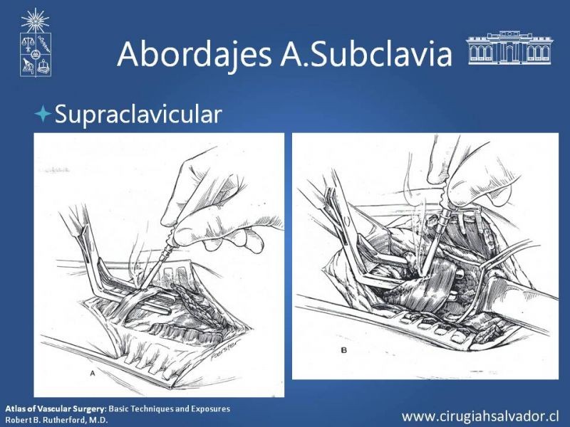 Diapositiva 22 de Anatomía Quirúrgica y Accesos de Carótida, vertebrales y subclavia