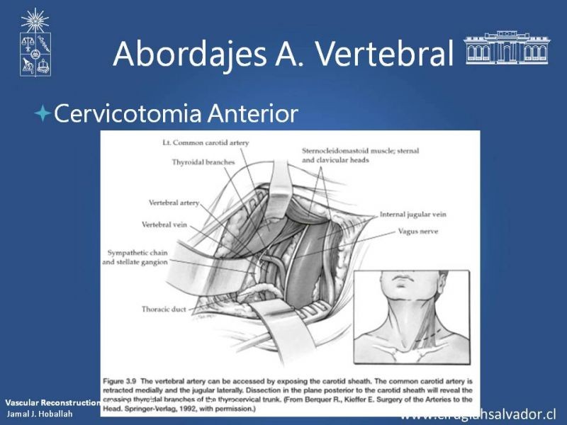 Diapositiva 28 de Anatomía Quirúrgica y Accesos de Carótida, vertebrales y subclavia