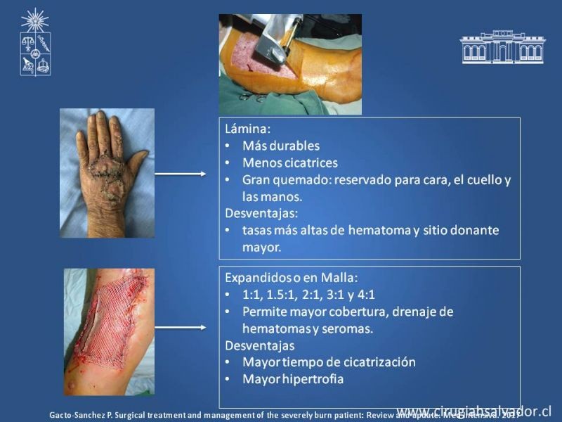 Diapositiva 22 de Manejo Quirúrgico del Gran Quemado