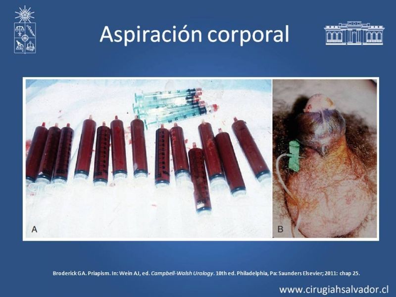 Diapositiva 20 de Priapismo
