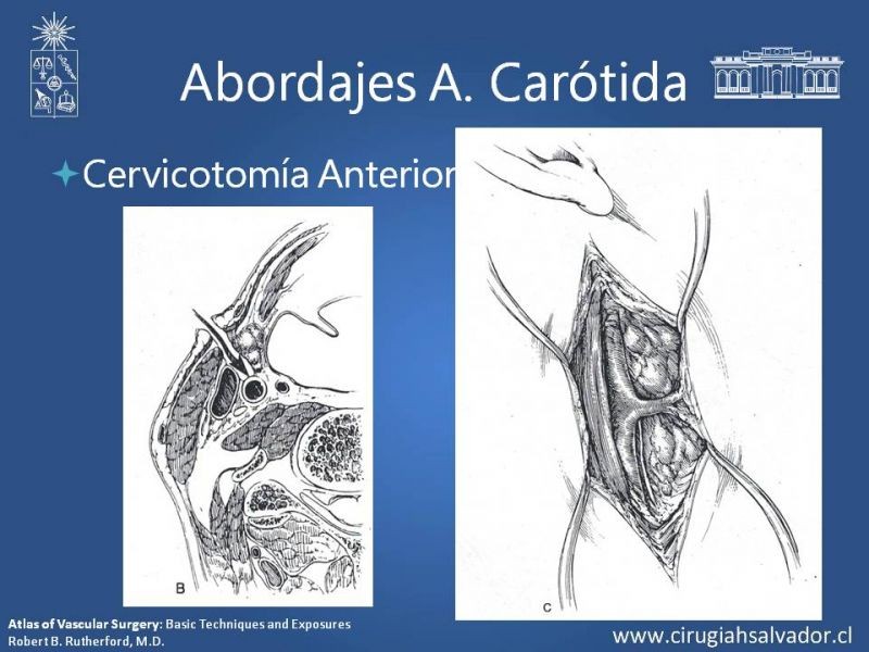 Diapositiva 31 de Anatomía Quirúrgica y Accesos de Carótida, vertebrales y subclavia