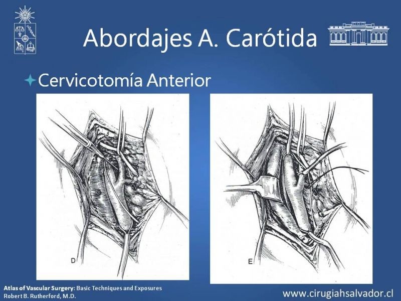 Diapositiva 32 de Anatomía Quirúrgica y Accesos de Carótida, vertebrales y subclavia