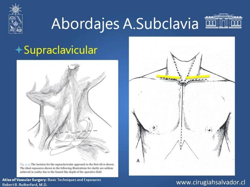 Diapositiva 20 de Anatomía Quirúrgica y Accesos de Carótida, vertebrales y subclavia