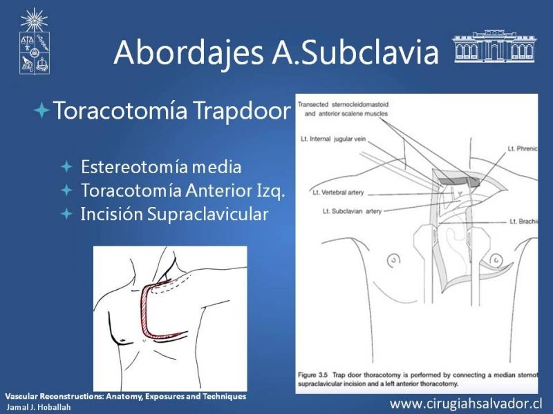 Diapositiva 18 de Anatomía Quirúrgica y Accesos de Carótida, vertebrales y subclavia