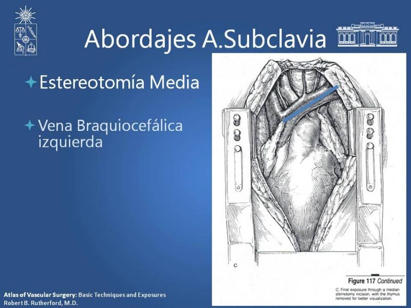 Diapositiva 13 de Anatomía Quirúrgica y Accesos de Carótida, vertebrales y subclavia