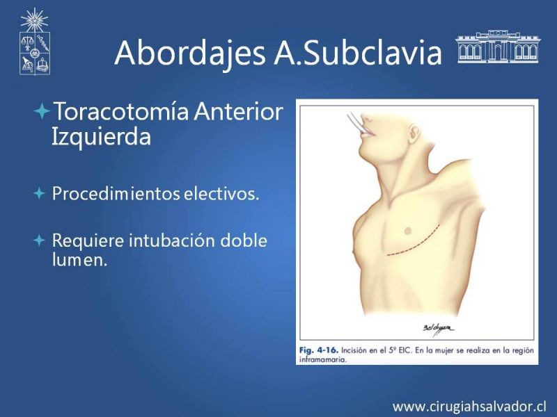 Diapositiva 16 de Anatomía Quirúrgica y Accesos de Carótida, vertebrales y subclavia