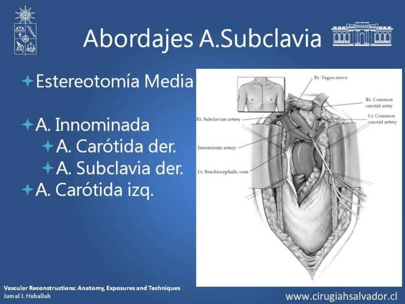 Diapositiva 14 de Anatomía Quirúrgica y Accesos de Carótida, vertebrales y subclavia