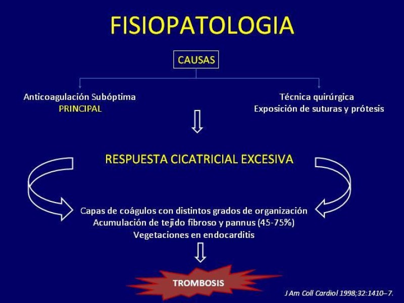 Diapositiva 13 de Trombosis de válvulas protésicas