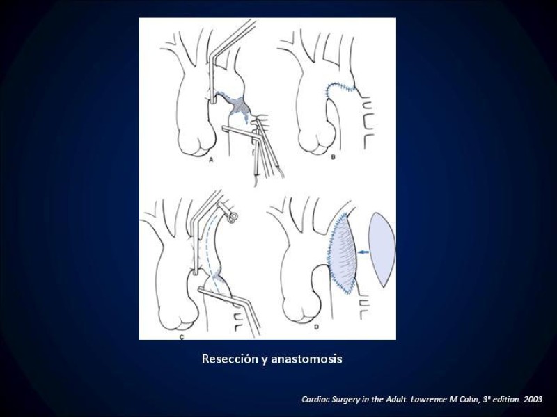Diapositiva 18 de Coartación Aortica