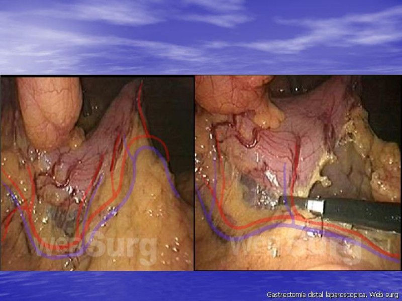Diapositiva 8 de Gastrectomía Laparoscópica Pt. II