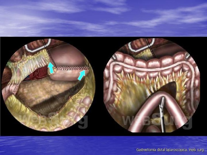 Diapositiva 24 de Gastrectomía Laparoscópica Pt. II