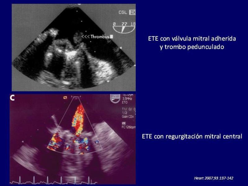 Diapositiva 22 de Trombosis de válvulas protésicas