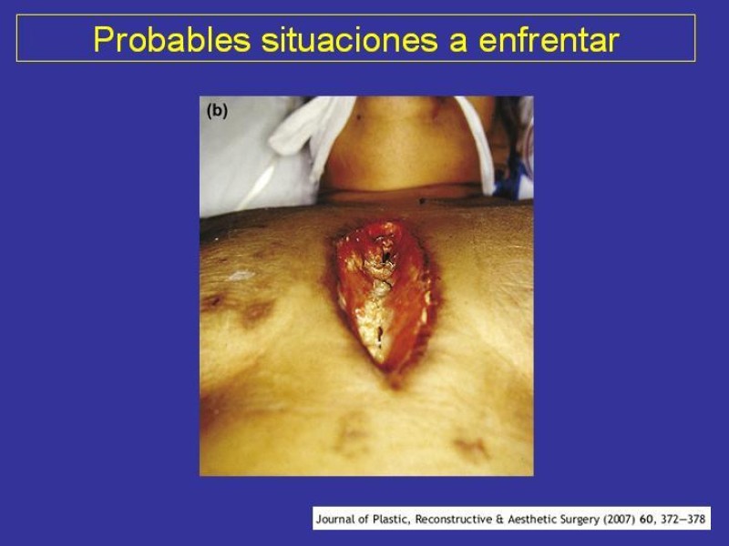 Diapositiva 32 de Mediastinitis