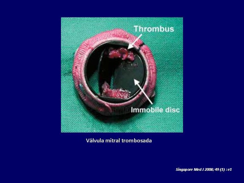 Diapositiva 39 de Trombosis de válvulas protésicas
