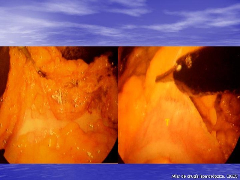 Diapositiva 6 de Gastrectomía Laparoscópica Pt. II