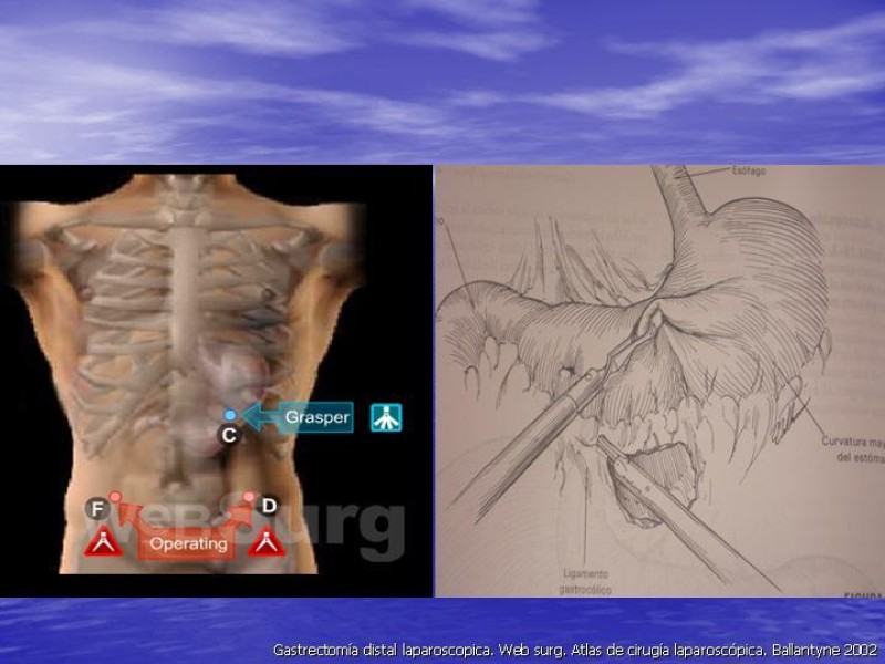 Diapositiva 5 de Gastrectomía Laparoscópica Pt. II