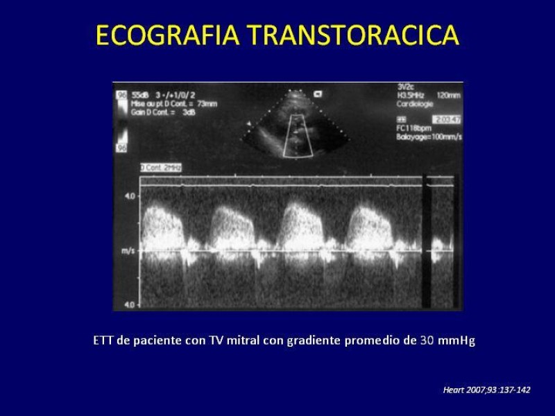 Diapositiva 19 de Trombosis de válvulas protésicas