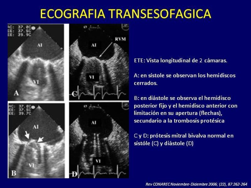 Diapositiva 23 de Trombosis de válvulas protésicas