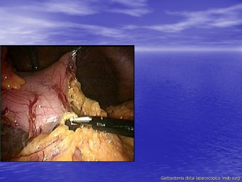 Diapositiva 9 de Gastrectomía Laparoscópica Pt. II
