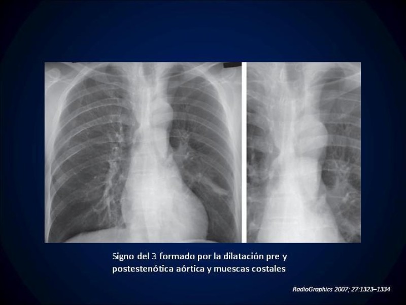 Diapositiva 9 de Coartación Aortica