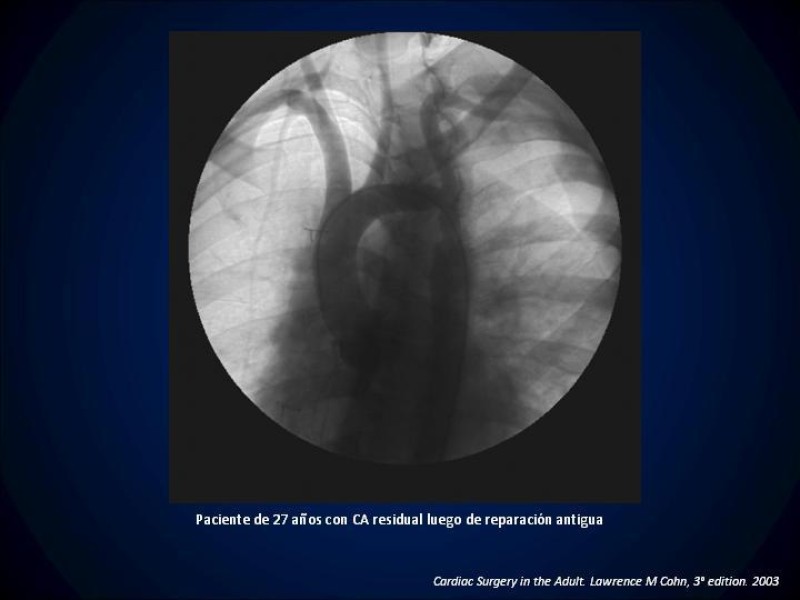 Diapositiva 13 de Coartación Aortica