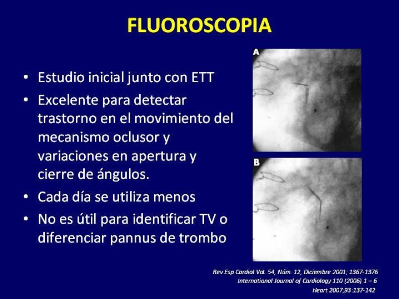 Diapositiva 25 de Trombosis de válvulas protésicas