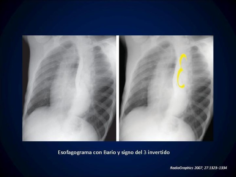 Diapositiva 10 de Coartación Aortica