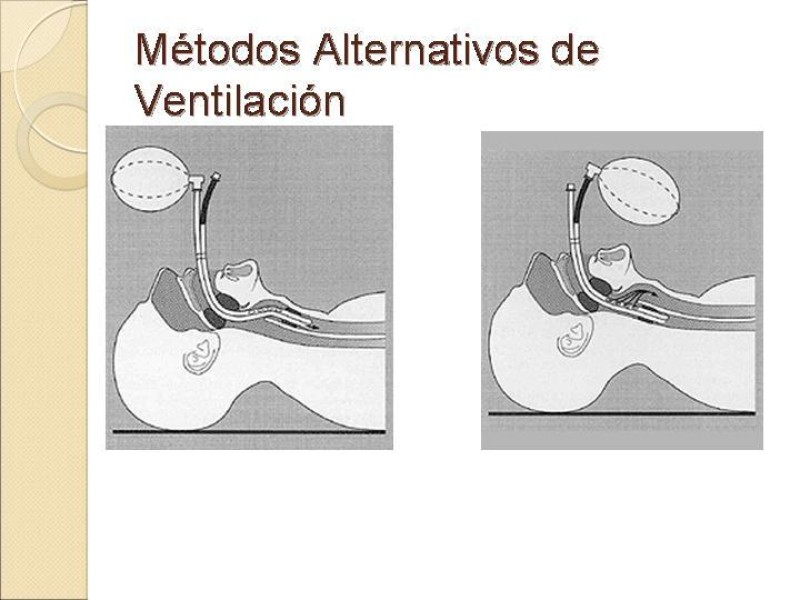 Diapositiva 14 de Manejo de la Vía Aérea Difícil