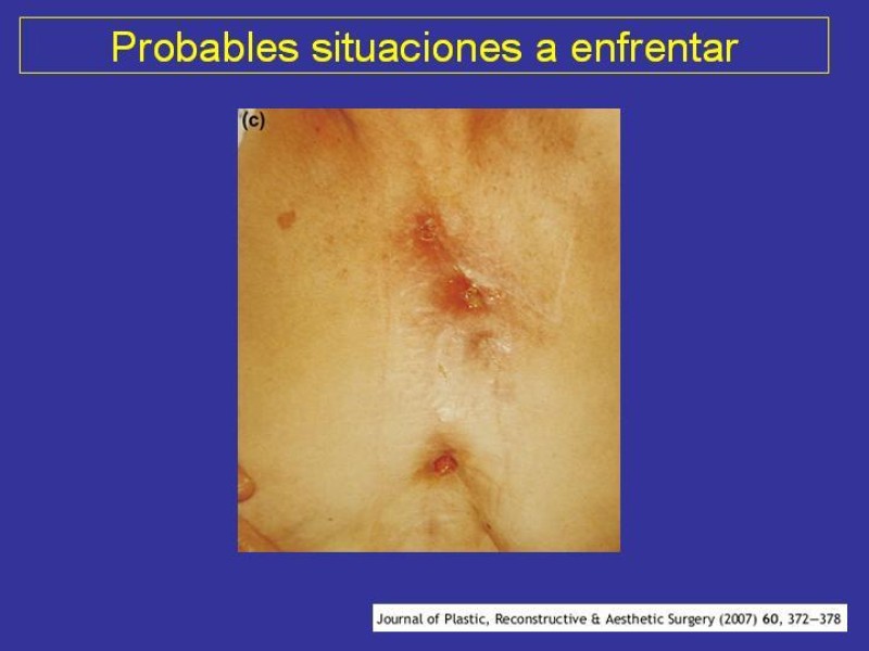 Diapositiva 33 de Mediastinitis