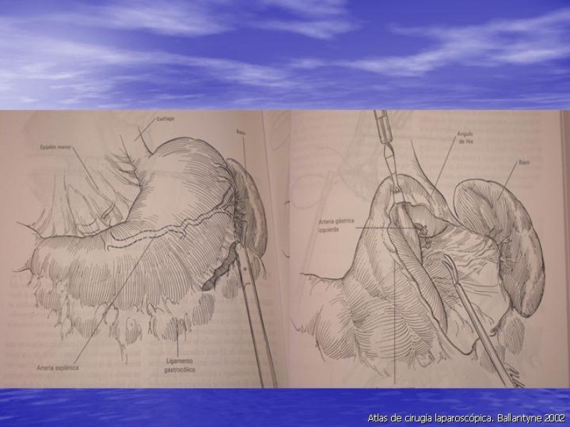 Diapositiva 29 de Gastrectomía Laparoscópica Pt. II