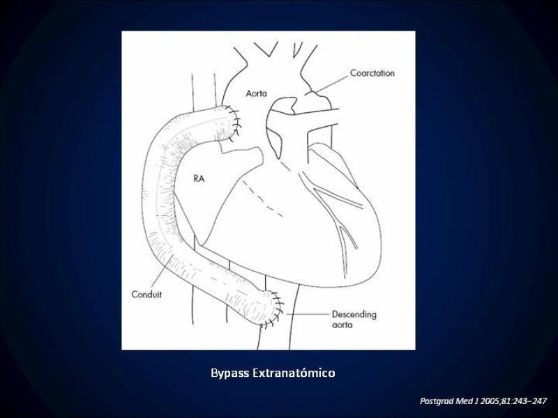 Diapositiva 20 de Coartación Aortica