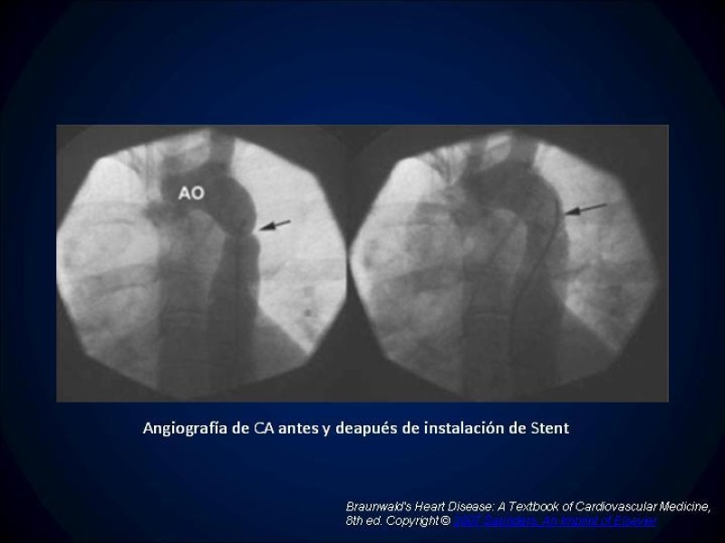 Diapositiva 24 de Coartación Aortica