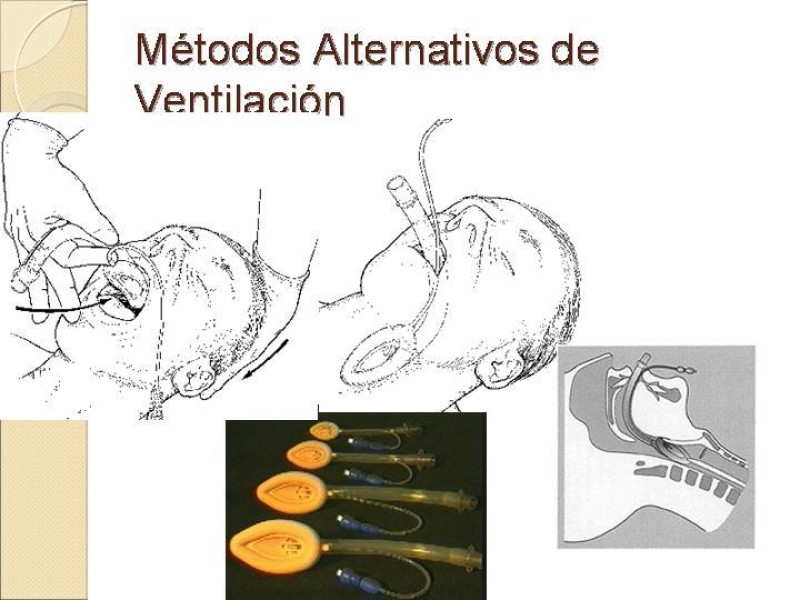 Diapositiva 11 de Manejo de la Vía Aérea Difícil