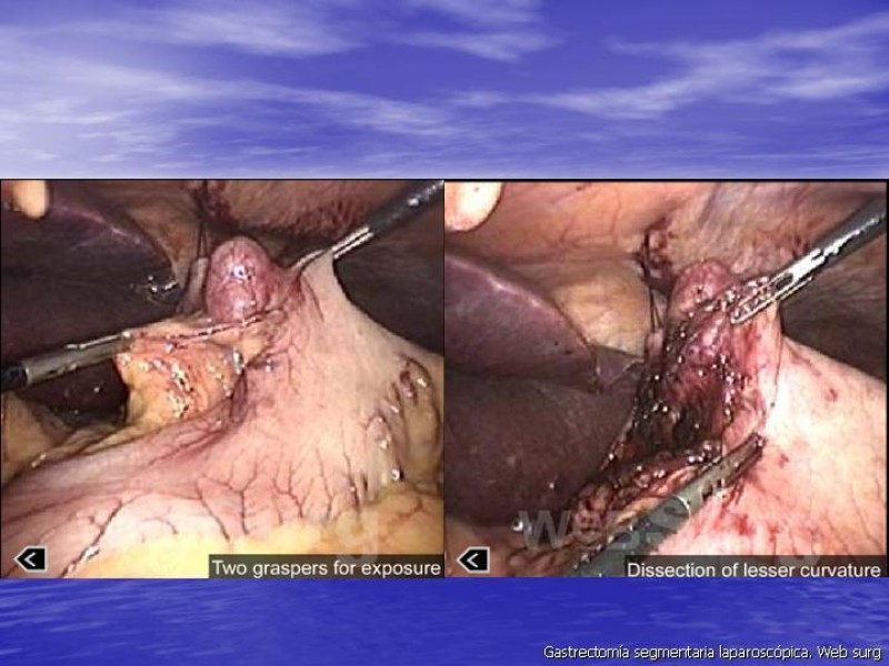 Diapositiva 35 de Gastrectomía Laparoscópica Pt. II