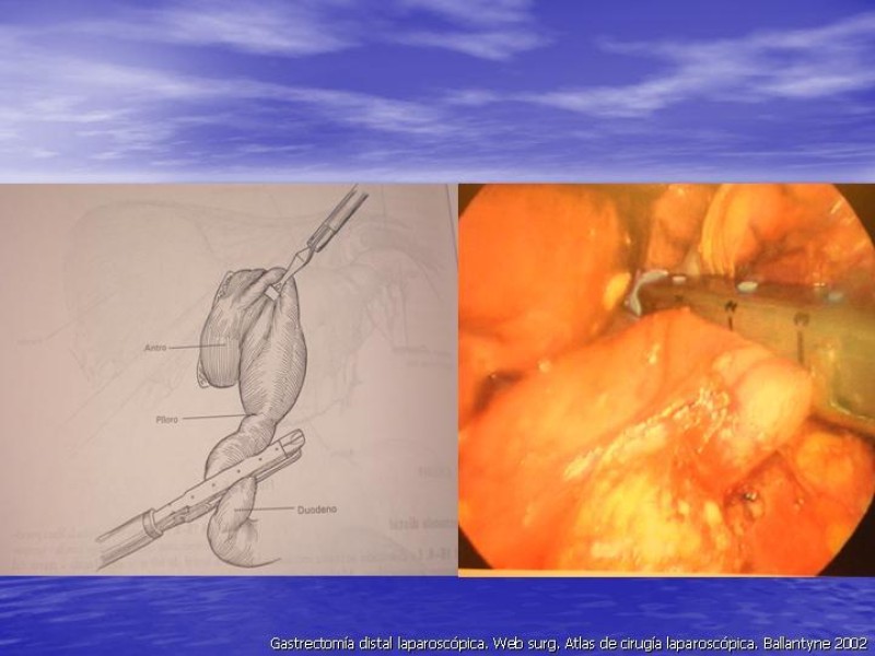Diapositiva 14 de Gastrectomía Laparoscópica Pt. II