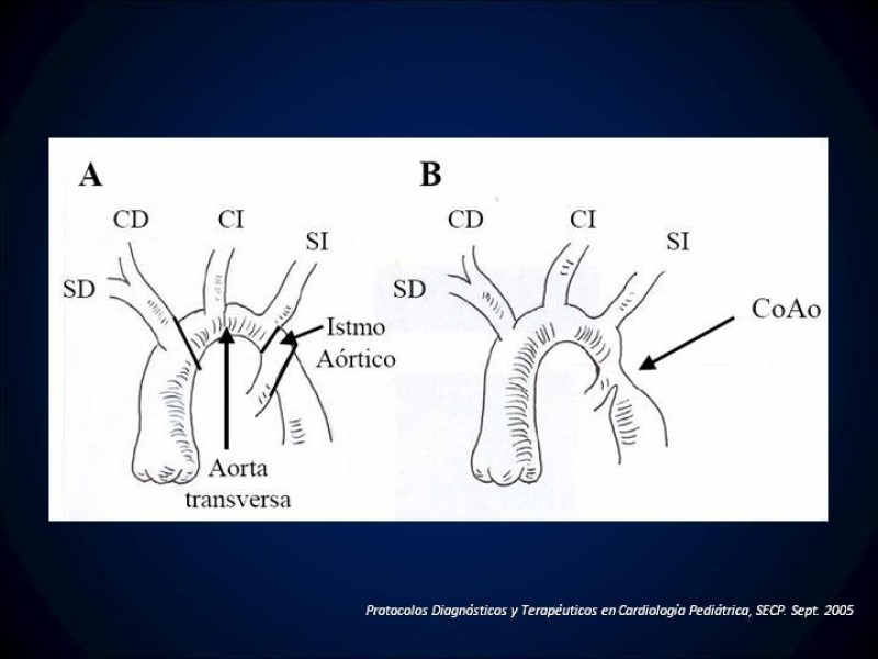 Diapositiva 2 de Coartación Aortica