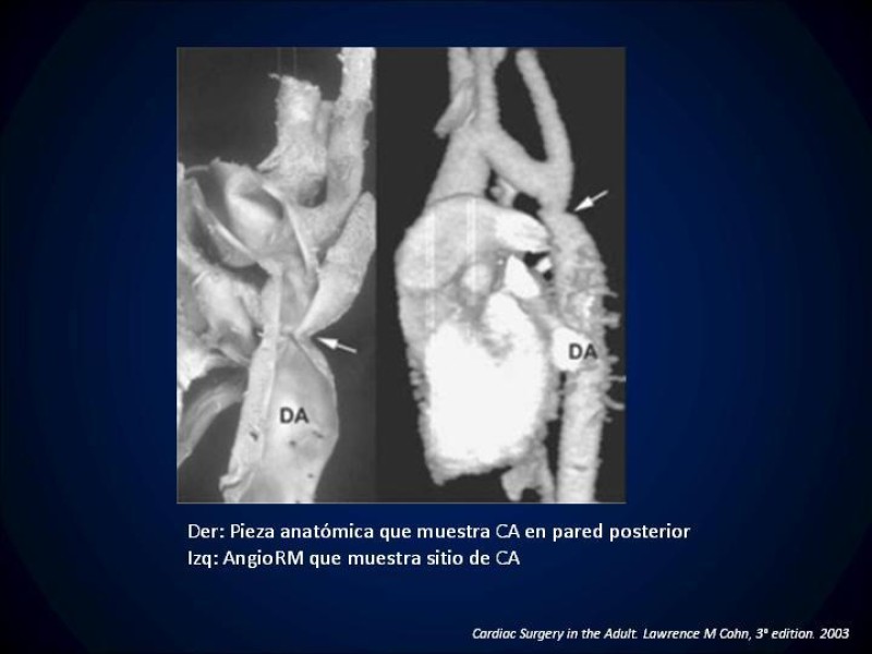 Diapositiva 15 de Coartación Aortica