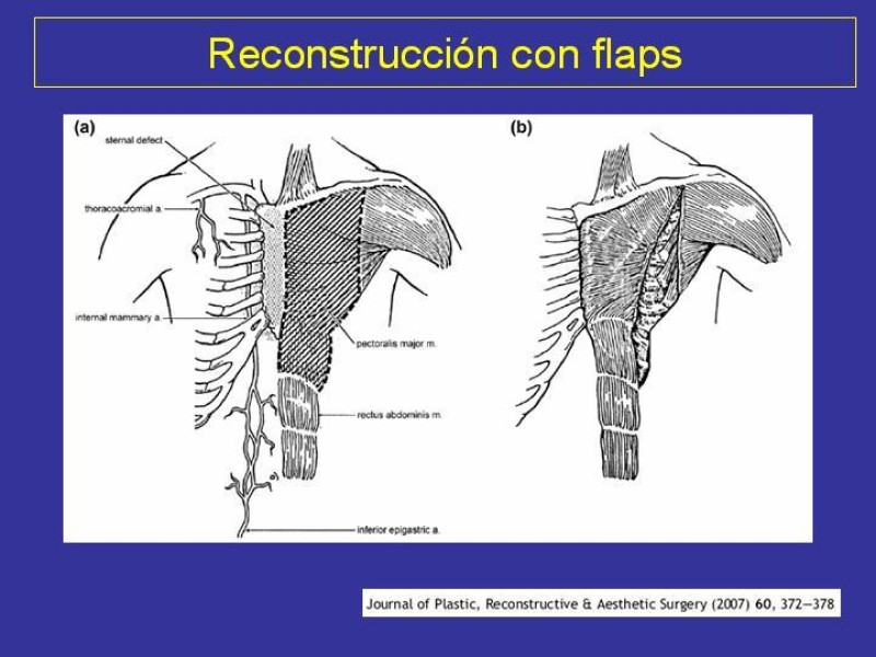 Diapositiva 37 de Mediastinitis