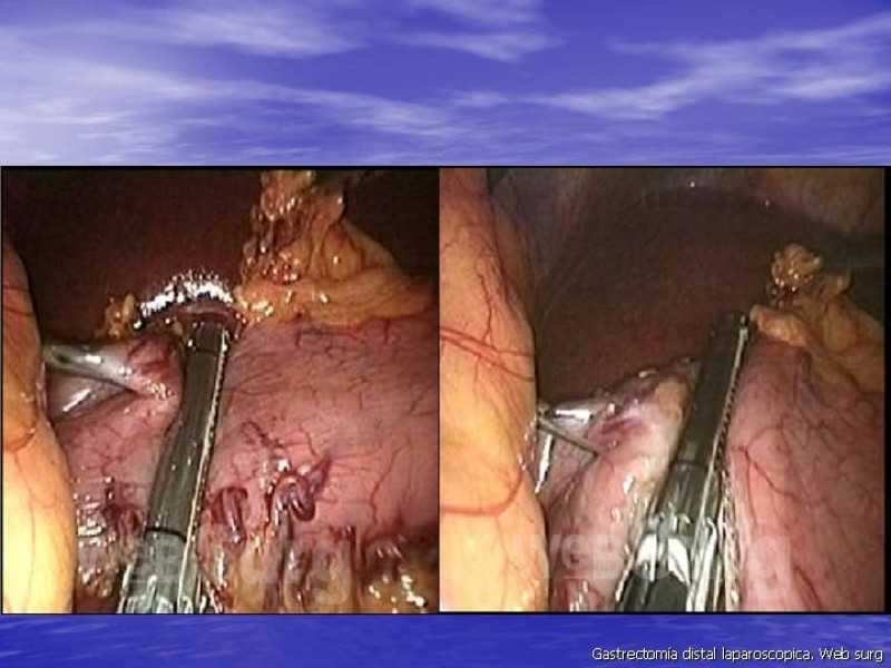 Diapositiva 12 de Gastrectomía Laparoscópica Pt. II