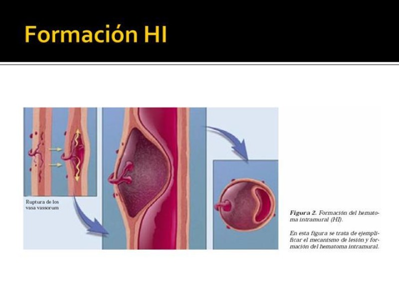 Diapositiva 7 de Disección de Aorta Torácica