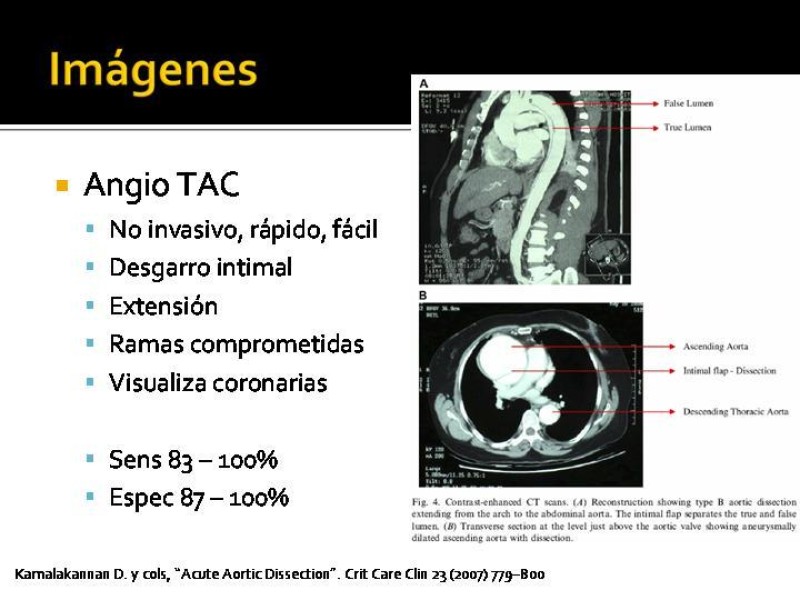 Diapositiva 22 de Disección de Aorta Torácica