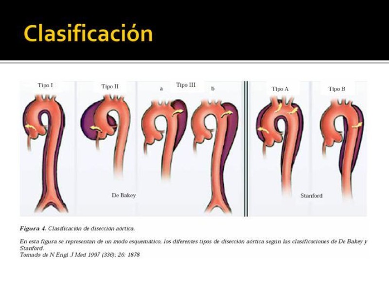 Diapositiva 12 de Disección de Aorta Torácica