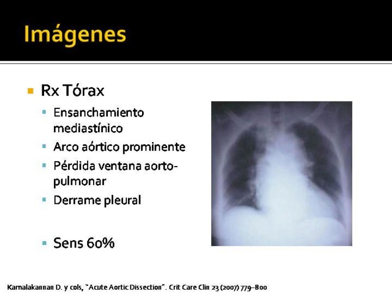 Diapositiva 20 de Disección de Aorta Torácica