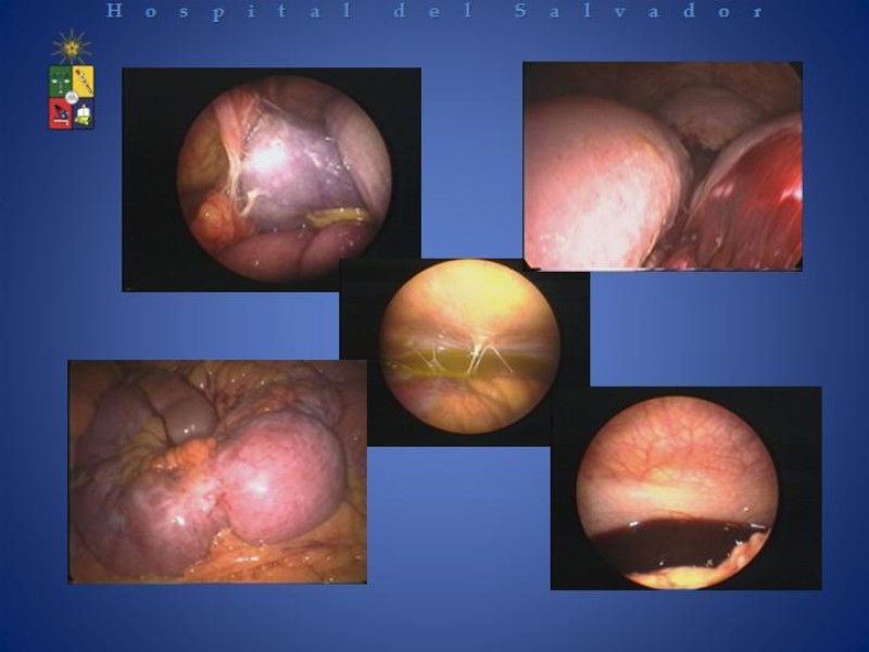 Diapositiva 18 de Laparoscopía Diagnóstica