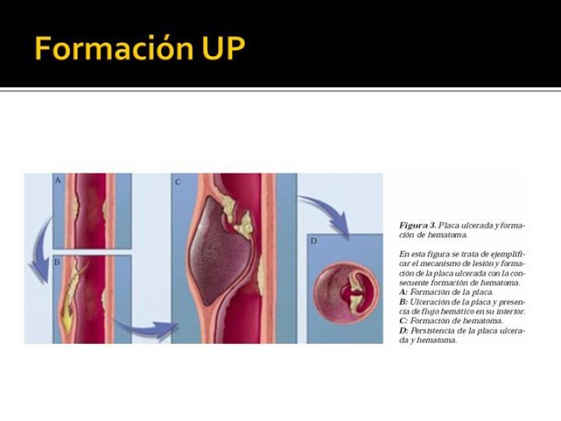 Diapositiva 9 de Disección de Aorta Torácica