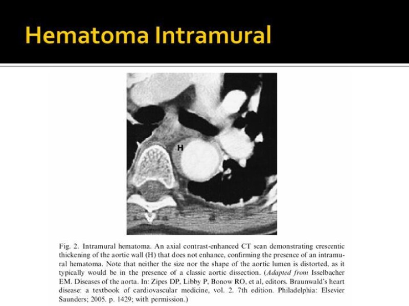 Diapositiva 8 de Disección de Aorta Torácica