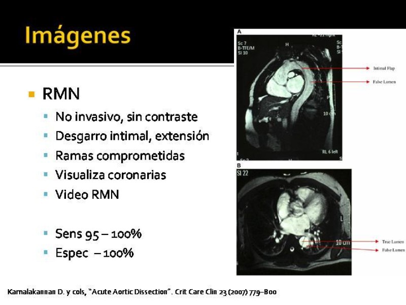 Diapositiva 23 de Disección de Aorta Torácica